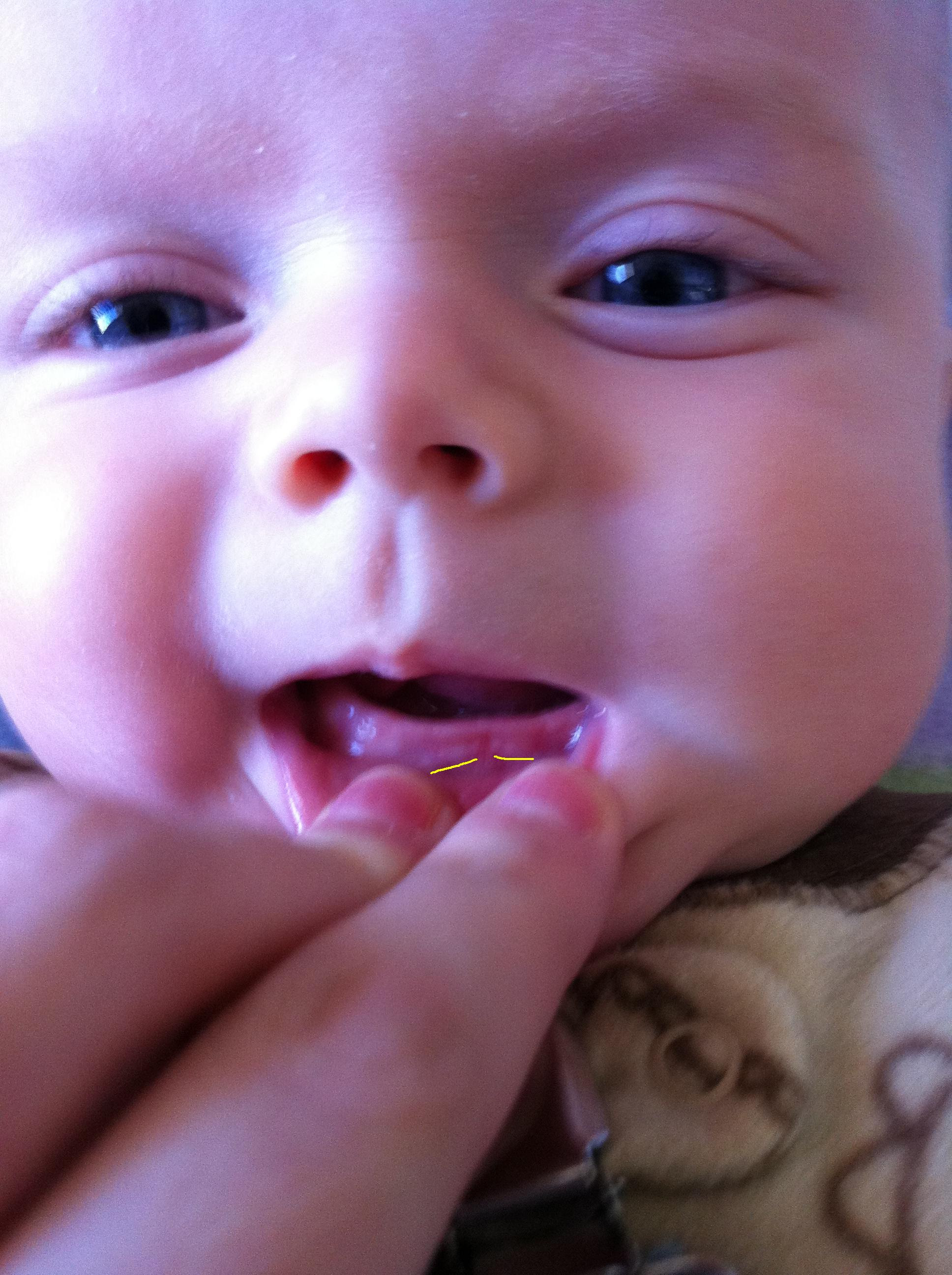 Лезут зубы у ребенка постоянно. Прорезывание зубов у детей. Десна при прорезывании зубов. Прорезывание первых зубов.
